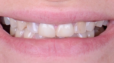 img-whitney-before.jpg